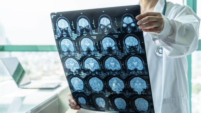 Low nitric oxide linked to faster Alzheimer’s decline